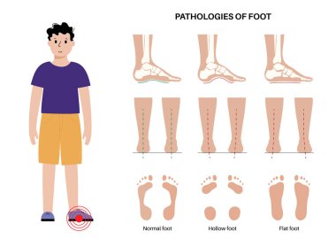 Ayak patolojisi anatomik poster. Düz, normal ve içi boş ayak koşulları. Anormal ayak kemeri, süsleme ve aşırı telaffuz. Ayak bileği patolojisi podiyatri kliniğinde tıbbi vektör çizimi.