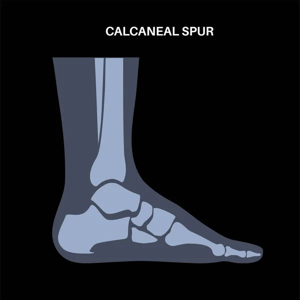 Calcaneal Spur Anatomy Foot Problem Diagnostic Treatment Podiatry Clinic Heel — Stock Vector