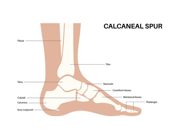 Calcaneal Spur Anatomy Foot Problem Diagnostic Treatment Podiatry Clinic Heel — Stock Vector