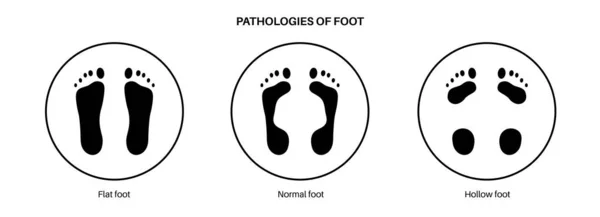 Patologiile Picioarelor Poster Anatomic Condiții Picioare Plate Normale Goale Arcadă — Vector de stoc