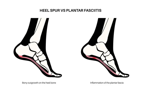 Calcaneal Spur Plantar Fasciitis Comparison Foot Diseases Treatment Heel Bone — Stock Vector