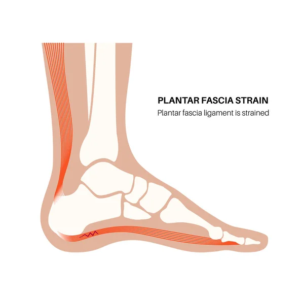 Plantar Fascia Strain Anatomical Poster Tear Soft Tissue Arch Foot — Stock Vector