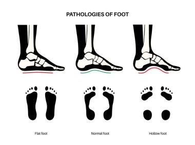 Ayak patolojisi anatomik poster. Düz, normal ve içi boş ayak koşulları. Anormal ayak kemeri, süsleme ve aşırı telaffuz. Ayak bileği patolojisi podiyatri kliniğinde tıbbi vektör çizimi.