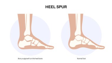 Calcaneal spur anatomisi. Ayak problemi, teşhis ve pediatri kliniğinde tedavi. Kalkaneal tüberkülozdan topuk kemiği büyümüş. Ayak bileği ağrısı ve şişkinlik. Ayak vektör illüstrasyonunun X ışını incelemesi