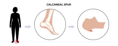 Calcaneal spur anatomisi. Ayak problemi, teşhis ve pediatri kliniğinde tedavi. Kalkaneal tüberkülozdan topuk kemiği büyümüş. Ayak bileği ağrısı ve şişkinlik. Ayak vektör illüstrasyonunun X ışını incelemesi