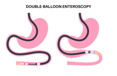 Çift balon enteroskopisi minimum invaziv prosedür. İnce bağırsağın görüntüsü. Biyopsi, polip çıkarma, kanama terapisi, gastrointestinal bölgede stent yerleştirme..