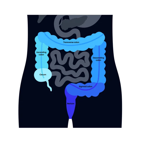 大肠解剖海报 人类肠道的一部分 胃肠科诊所消化道检查和治疗 教育用结肠信息图 孤立的病媒图解 — 图库矢量图片
