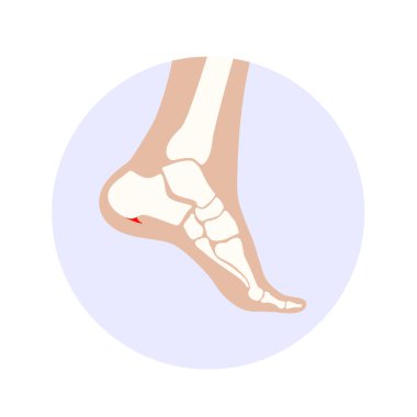 Calcaneal mahmuz ikonu. Ayak problemi, teşhis ve podiyatri kliniğinde tedavi. Kalkaneal tüberkülozdan topuk kemiği büyümüş. Ayak bileği ağrısı ve şişkinlik. Ayak vektör illüstrasyonunun X ışını incelemesi