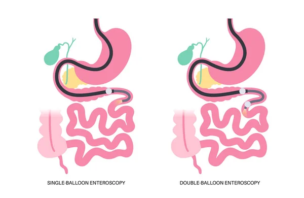 stock vector Double and single balloon enteroscopy minimally invasive procedure. Visualization of the small intestine. Biopsy, polyp removal, bleeding therapy or stent placement in gastrointestinal tract .poster.