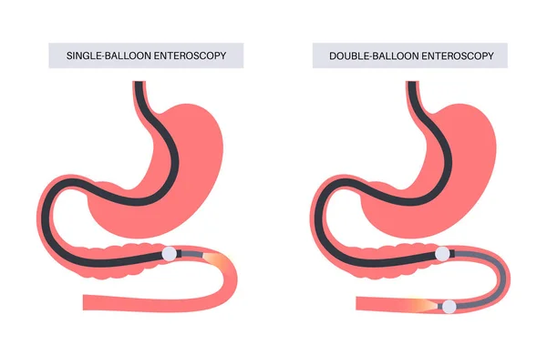 Dvojitá Jednoduchá Enteroskopie Balónu Minimálně Invazivní Procedura Vizualizace Tenkého Střeva — Stockový vektor