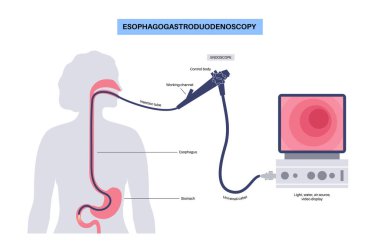 Esophagogastroduodenoskopi tıbbi posteri. Tanısal endoskopik minimal invaziv prosedür. Orofarenks, yemek borusu, mide ve proksimal duodenumun görüntülenmesi. Gastroenteroloji düz vektörü