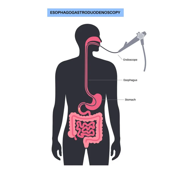 Affiche Médicale Oesophagogastroduodénoscopie Diagnostic Endoscopique Procédure Mini Invasive Visualisation Oropharynx — Image vectorielle