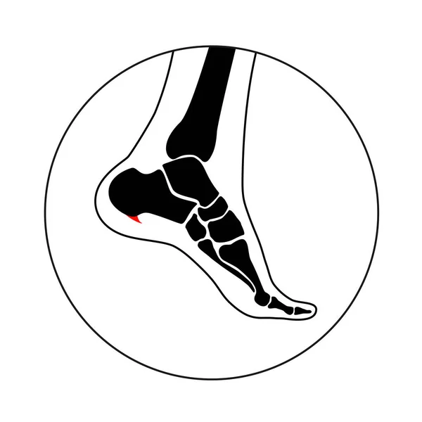Calcaneal Spur Icon Foot Problem Diagnostic Treatment Podiatry Clinic Heel — Stock Vector
