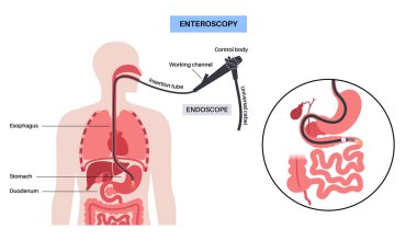 Balon destekli enteroskopi. İnce bağırsak ameliyatsız ameliyatının görselleştirilmesi. Gastrobağırsak yolu muayenesi. Biyopsi, polip çıkarma, kanama terapisi veya stent yerleştirme vektörü çizimi