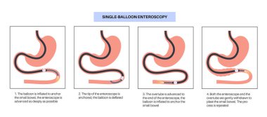 Tek balon enteroskopisi prosedürü. İnce bağırsak cerrahi olmayan tekniğinin görselleştirilmesi. Gastrobağırsak yolu sorunu. Biyopsi, polip çıkarma, kanama terapisi veya stent yerleştirme düz vektörü