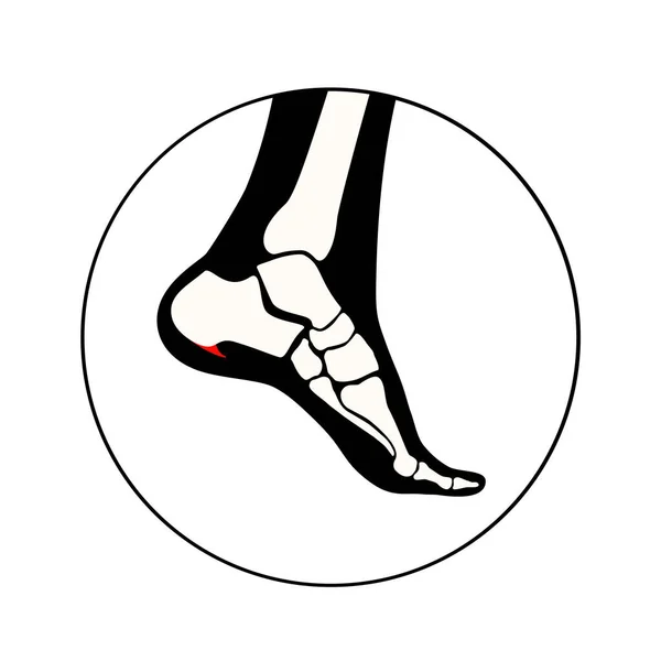 Calcaneal Spur Icon Foot Problem Diagnostic Treatment Podiatry Clinic Heel — Stock Vector