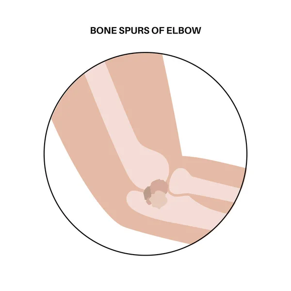 Bone Spur Removement Elbow Joint Minimally Invasive Surgery Arthroscopy Medical — Stock Vector