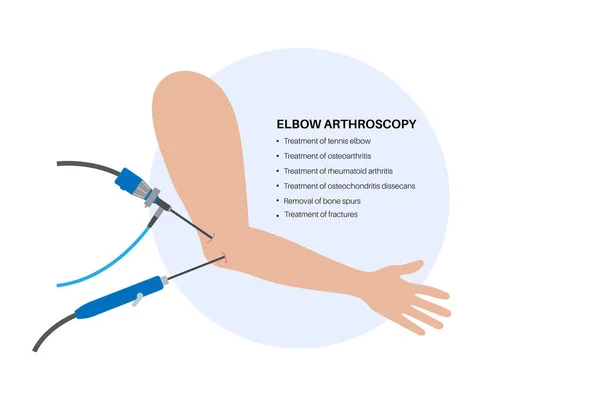 Elbow Joint Minimally Invasive Surgery Arthroscopy Medical Procedure Arthroscope Arthroscopic — Stock Vector