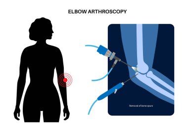 Dirsek eklemi minimal invaziv ameliyat. Artroskopi tıbbi prosedürü. Kol kemiği, dirsek kemiği ve ön kol kemiği anatomisi. Kol ağrısı, kırık, osteoartrit veya romatoid artrit x ışını çizimi