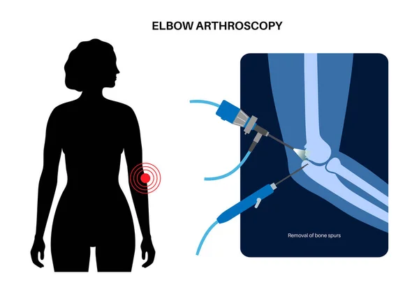 Elbow Joint Minimally Invasive Surgery Arthroscopy Medical Procedure Anatomy Humerus — Stock Vector