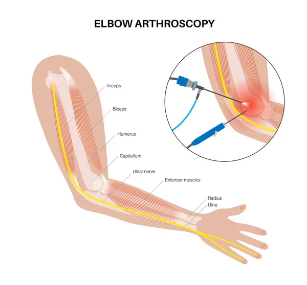 Elbow Joint Minimally Invasive Surgery Arthroscopy Medical Procedure Anatomy Humerus — Stock Vector