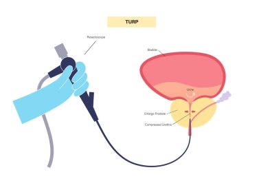 Prostatın transseksüel rezeksiyonu. Tıbbi prosedürü uygula. Prostat bezinin bir kısmının cerrahi müdahaleyle alınması. BPH tedavi posteri. Mesane vektör illüstrasyonunun anatomik tıbbi posteri