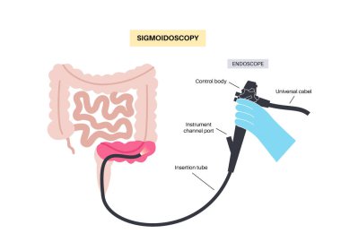 Kolonoskopi ve sigmoidoskopi testi. Kalın bağırsağın muayene ve tedavisi. Kolon bozukluğu, iltihaplı bağırsak hastalığı, kabızlık ya da idrar tutamama. Gastrointestinal tıbbi vektör