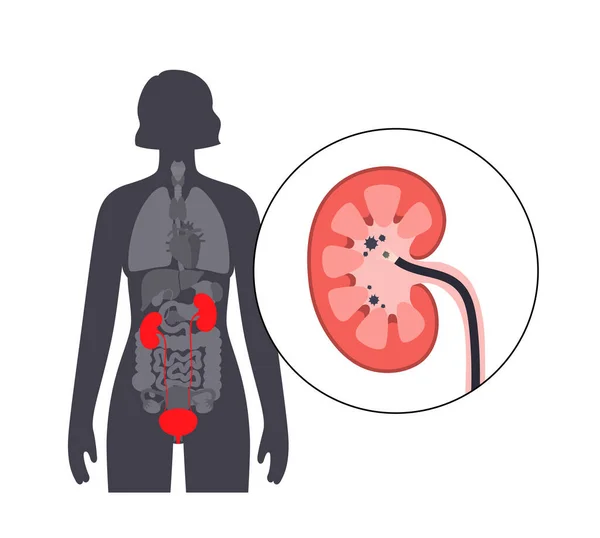 ウレタロスコピーは 最小限の侵襲的手順である 腎臓の検査と治療について 尿素系 ポリープ 石または炎症の障害 尿路医療ベクターのポスター — ストックベクタ