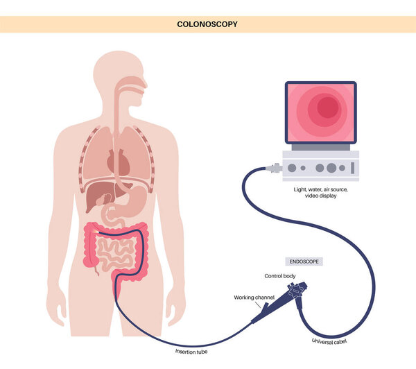 Colonoscopy is a minimally invasive procedure. Examination and treatment of the large intestine. Disorder of the colon, polyps, inflammation or swelling of bowel. Gastrointestinal disorder flat vector