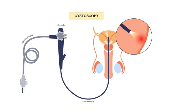 stock vector Cystoscopy is a minimally invasive procedure. Examination and treatment of the bladder. Disorder of the urinary system, cancer, polyps, stones or inflammation. Urinary tract medical poster flat vector