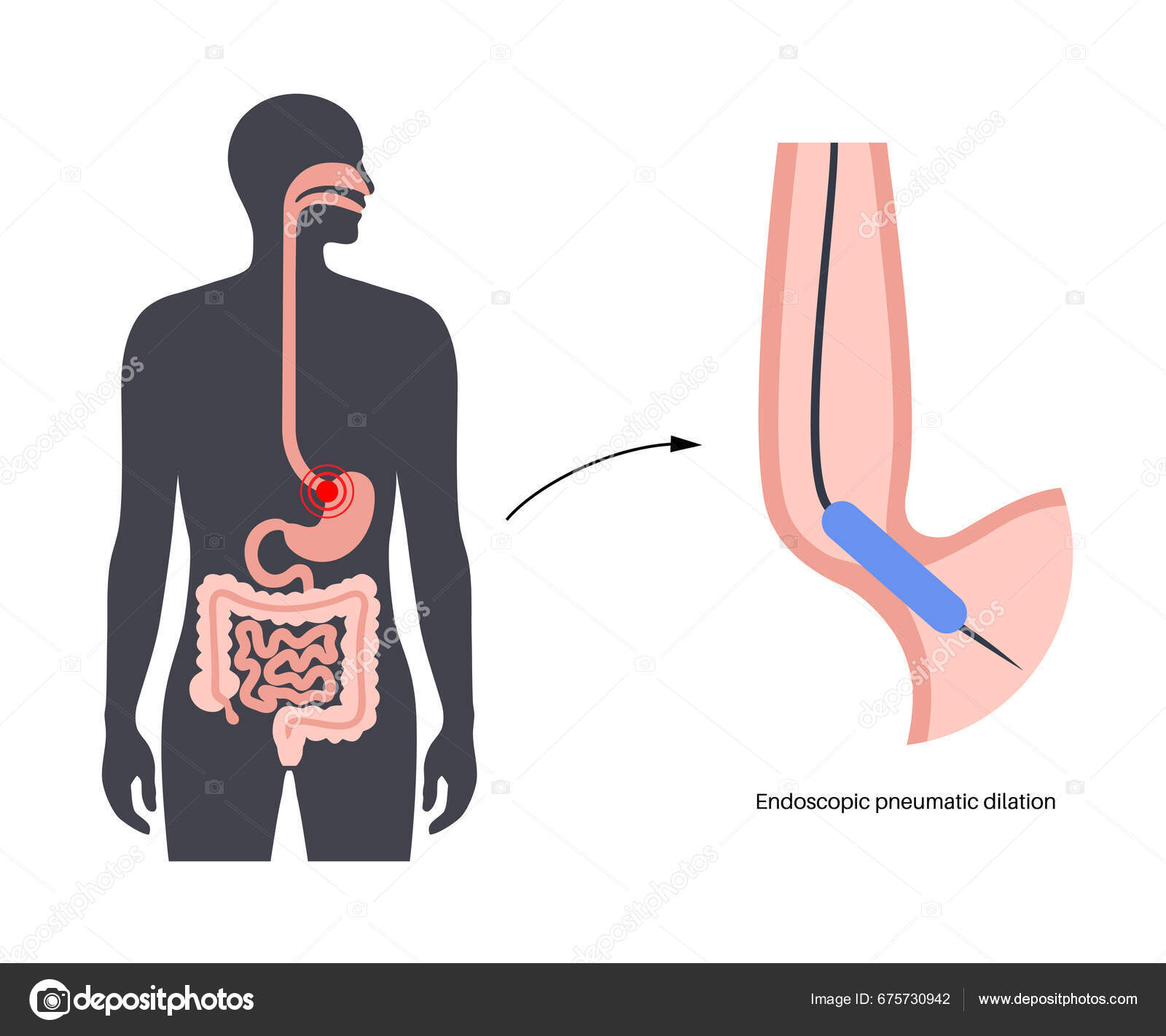 Endoscopic Pneumatic Dilation Upper Endoscopy Minimally Invasive Procedure Disorder Esophagus