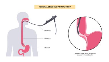 Peroral endoskopik miyotomi. Şiir, minimal invaziv prosedür. Yemek borusunda bozukluk, akhalasya hastalığı. Kapalı özofajiyal sfinkter, gastroözofajiyal anatomik poster çizimi