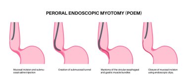 Peroral endoskopik miyotomi. Şiir, minimal invaziv prosedür. Yemek borusunda bozukluk, akhalasya hastalığı. Kapalı özofajiyal sfinkter, gastroözofajiyal anatomik poster çizimi
