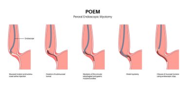 Peroral endoskopik miyotomi. Şiir, minimal invaziv prosedür. Yemek borusunda bozukluk, akhalasya hastalığı. Kapalı özofajiyal sfinkter, gastroözofajiyal anatomik poster çizimi