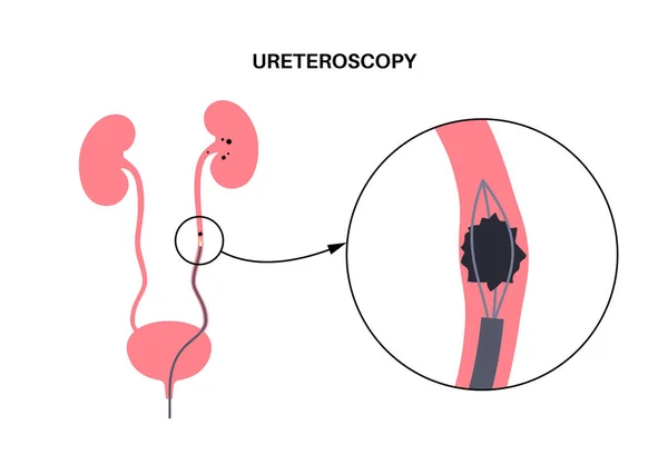 Stock vector Ureteroscopy is a minimally invasive procedure. Examination and treatment of the kidney. Disorder of the urinary system, cancer, polyps, stones or inflammation. Poster of urinary tract medical vector