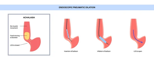 Dilasi Pneumatik Endoscopic Bagian Atas Endoskopi Prosedur Invasif Minimal Gangguan - Stok Vektor