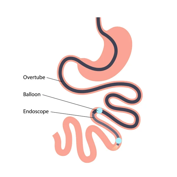 二重気球のエントロピー 最小侵襲的なプロシージャ 小腸の視覚化について バイオプシー ポリープ除去 出血療法 胃腸管のステント配置 ベクトルイラスト — ストックベクタ