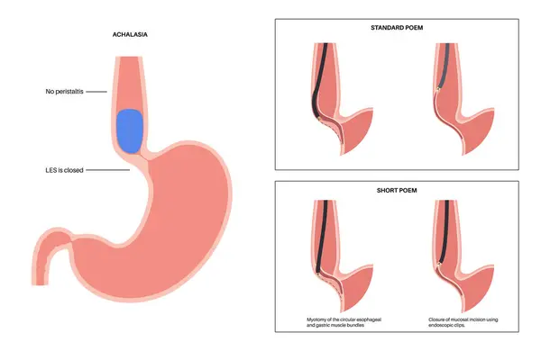 Peroral Endoscopic Myotomy Poem Minimally Invasive Procedure Disorder Esophagus Achalasia — Stock Vector