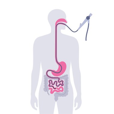 Esophagogastroduodenoskopi tıbbi posteri. Tanısal endoskopik minimal invaziv prosedür. Orofarenks, yemek borusu, mide ve proksimal duodenumun görüntülenmesi. Gastroenteroloji düz vektörü