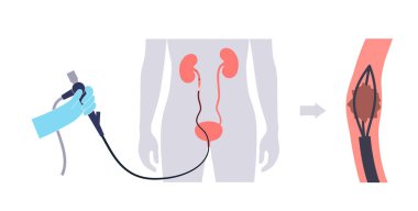 Ureteroskopi çok az invaziv bir işlemdir. Böbreğin muayene ve tedavisi. İdrar sistemi bozukluğu, kanser, polip, taş ya da iltihap. İdrar yolu tıbbi vektörünün posteri