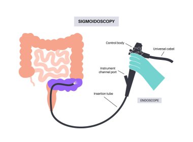 Kolonoskopi ve sigmoidoskopi testi. Kalın bağırsağın muayene ve tedavisi. Kolon bozukluğu, iltihaplı bağırsak hastalığı, kabızlık ya da idrar tutamama. Gastrointestinal tıbbi vektör