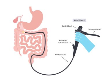Kolonoskopi asgari invaziv bir işlemdir. Kalın bağırsağın muayene ve tedavisi. Kalın bağırsak düzensizliği, polipler, iltihap ya da bağırsak şişmesi. Gastrointestinal bozukluk düz vektör