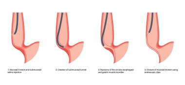 Peroral endoskopik miyotomi. Şiir, minimal invaziv prosedür. Yemek borusunda bozukluk, akhalasya hastalığı. Kapalı özofajiyal sfinkter, gastroözofajiyal anatomik poster çizimi