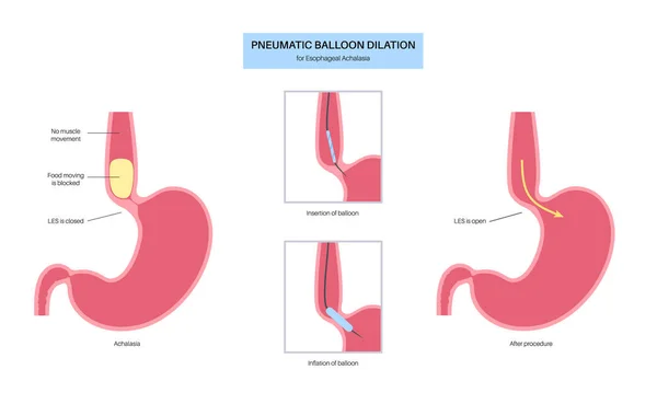 Stock vector Endoscopic pneumatic dilation. Upper endoscopy minimally invasive procedure. Disorder of the esophagus, therapy for achalasia. balloon disrupts the muscle fibers in closed lower esophageal sphincter