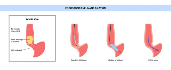 Dilasi Pneumatik Endoscopic Bagian Atas Endoskopi Prosedur Invasif Minimal Gangguan - Stok Vektor