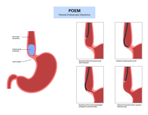 Perorale Endoskopische Myotomie Poem Minimalinvasives Verfahren Störung Der Speiseröhre Achalasia — Stockvektor