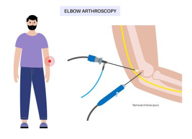Kemik çıkarılması. Dirsek eklemi minimal invaziv ameliyat. Artroskopi tıbbi prosedürü. Kol kemiği, dirsek kemiği ve ön kol kemiği anatomisi. Kol ağrısı, şişkinlik ve iltihap, x ışını vektör çizimi
