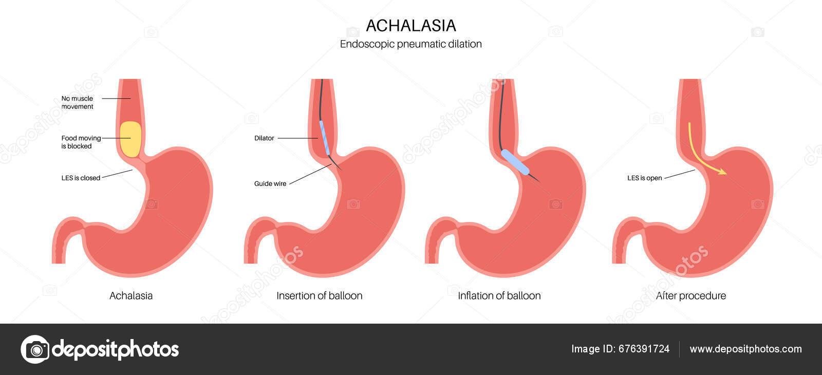 Endoscopic Pneumatic Dilation Upper Endoscopy Minimally Invasive Procedure Disorder Esophagus