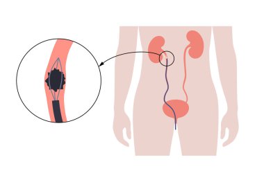 Ureteroskopi çok az invaziv bir işlemdir. Böbreğin muayene ve tedavisi. İdrar sistemi bozukluğu, kanser, polip, taş ya da iltihap. İdrar yolu tıbbi vektörünün posteri