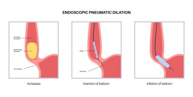 Endoskopik pnömatik genişleme. Üst endoskopi minimum invaziv prosedür. Yemek borusunda bozukluk, akhalasya tedavisi. Balon, kapalı yemek borusu sfinkterisindeki kas liflerini bozar.